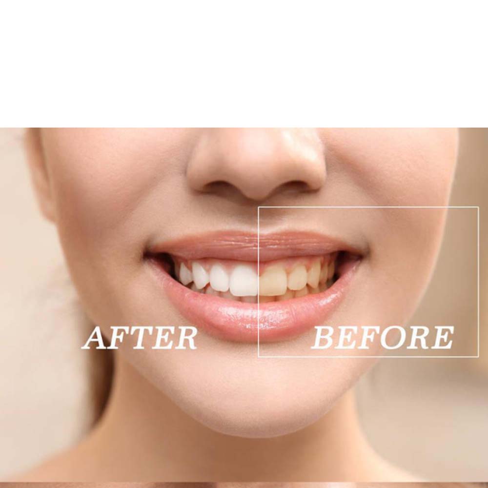 최고 품질의 과산화물 치아 미백 젤 키트 표백 시스템  - Teeth Whitening Bleaching Kit 리뷰 및 가격