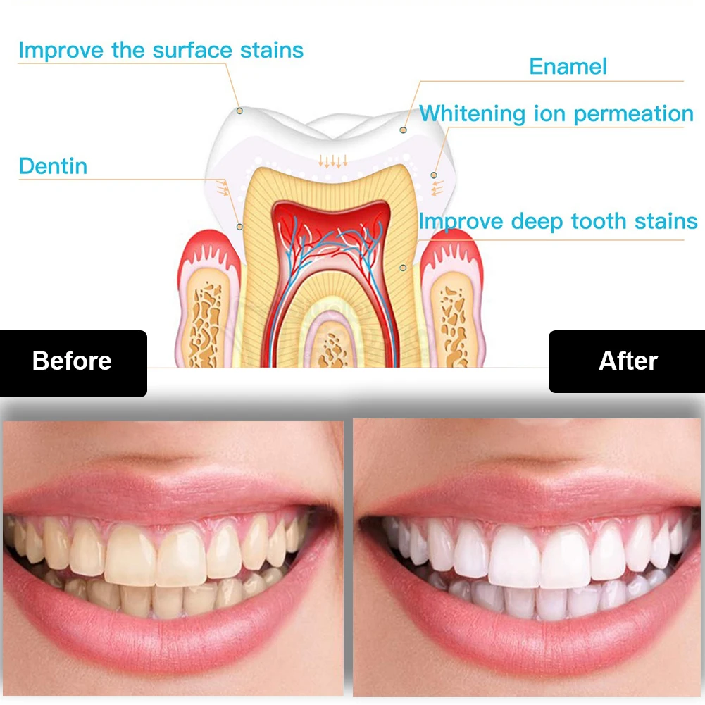 치과 치아 미백 키트 미니 16 LED 콜드 라이트 3 - Teeth Whitening Q&M 리뷰 및 가격